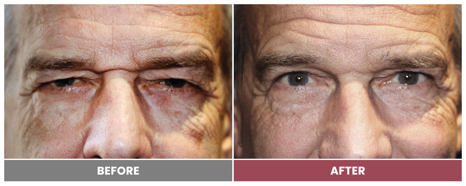Upper Blepharoplasty - Case 106